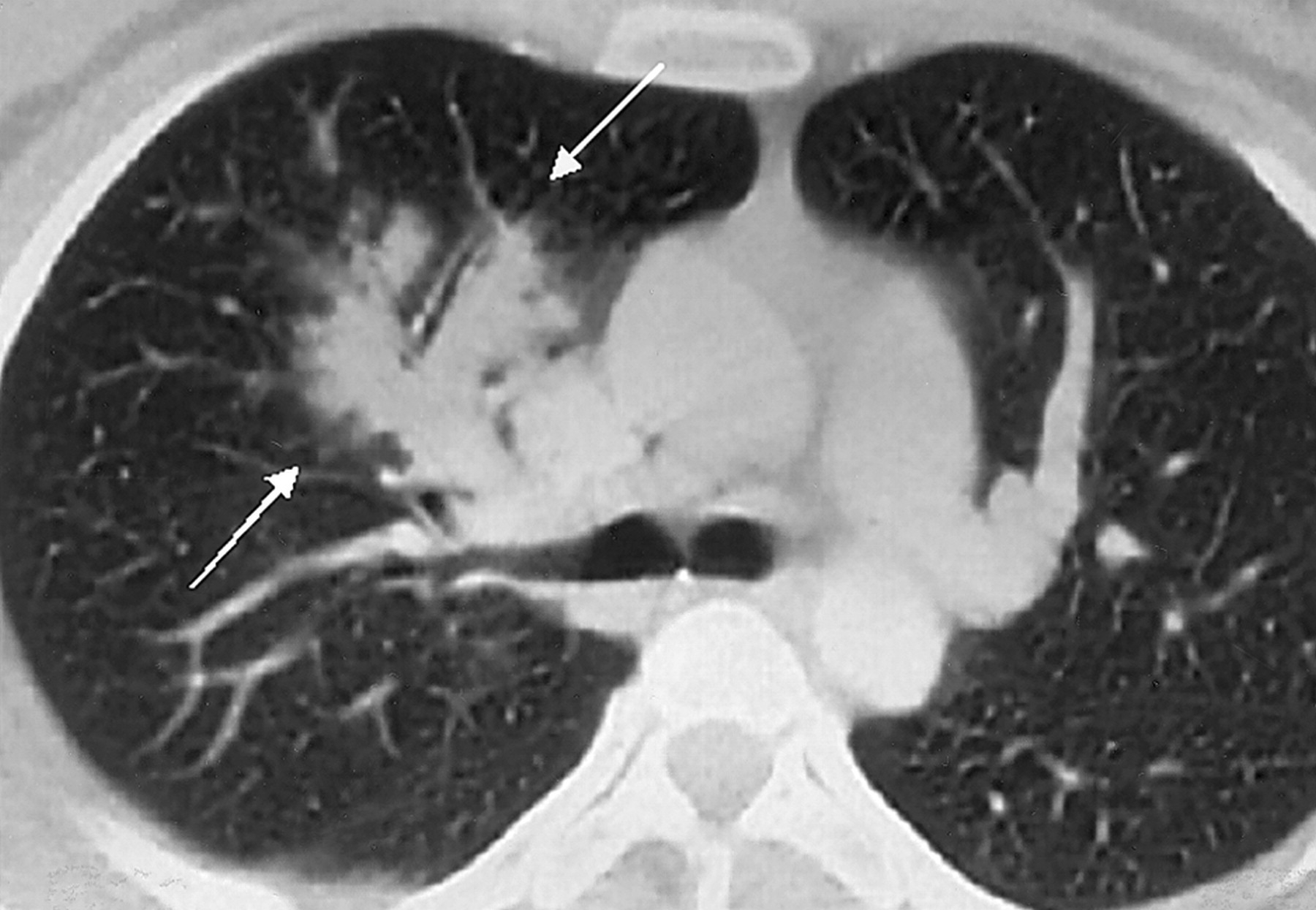 Pneumoniile infectioase